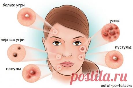 Виды акне: белые угри, черные угри, папулы, пустулы, кисты