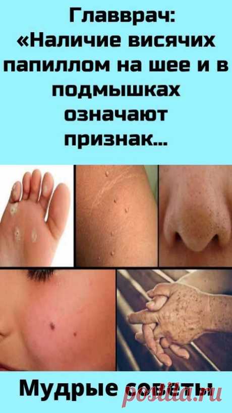 Главврач: «Наличие висячих папиллом на шее и в подмышках означают признак ранней… Чтобы убрать, | здоровье