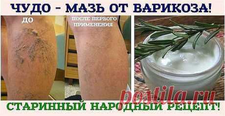 ЧУДО - МАЗЬ ОТ ВАРИКОЗА!