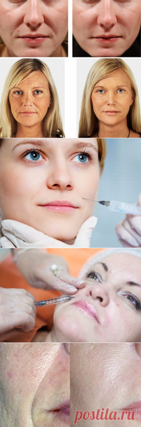 Носогубные складки. Гиалуроновая кислота, фото до и после