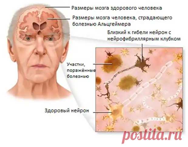 Здоровье мозга