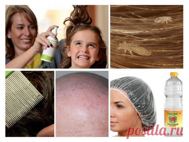 Борьба с педикулезом у ребенка и взрослого Уничтожение паразитов Народные методы лечения Педикулез – распространенное и довольно опасное заболевание. Вши являются переносчиками инфекций, одной из них является тиф. Однако не только этим опасен педикулез: постоянный зуд, беспокойный сон, невозможность комфортно чувствовать себя в обществе и...