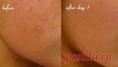 Маска от пятен от прыщей.