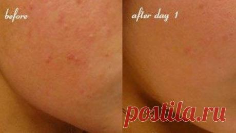 Маска от пятен от прыщей.