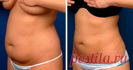 Мой лучший результат: Благодаря копеечному аптечному средству  и двум упражнениям, убрала жир с живота + похудела на 8 кг. | Худеем Дома | Яндекс Дзен