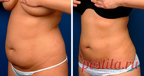 Мой лучший результат: Благодаря копеечному аптечному средству  и двум упражнениям, убрала жир с живота + похудела на 8 кг. | Худеем Дома | Яндекс Дзен