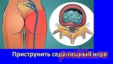 Приструнить седалищный нерв.