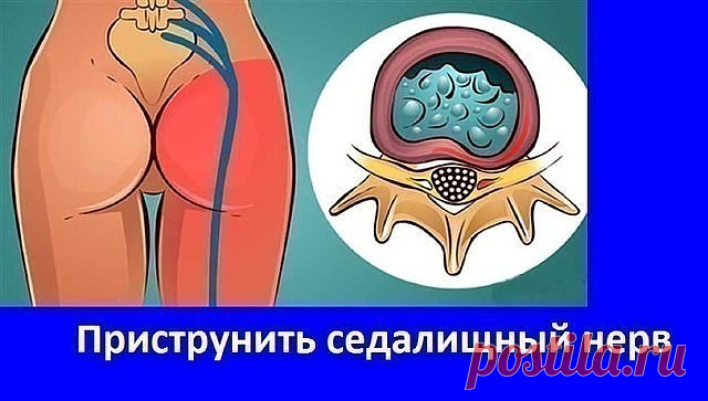 Приструнить седалищный нерв.