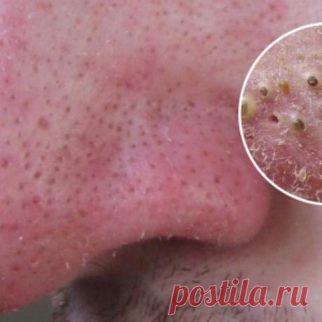 Избавься от этих гадких черных точек немедленно! И вот как это делается…