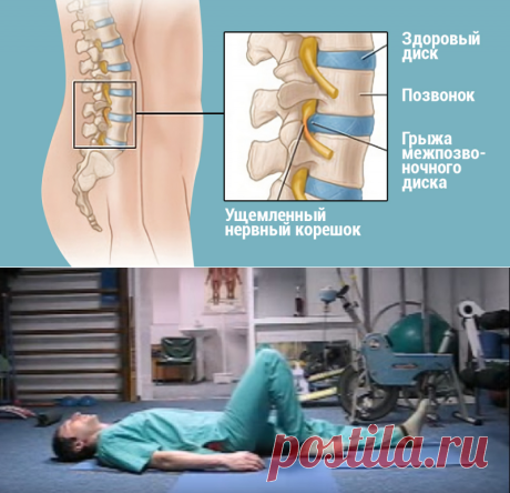 Лечение межпозвонковой грыжи