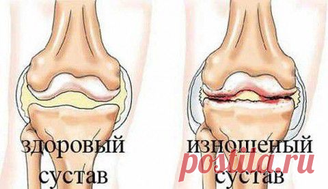 Рецепт настойки из алоэ, нашатыря и скипидара от боли в суставах.