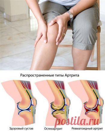 Популярные вопросы про артрит и ответы на них / Будьте здоровы
