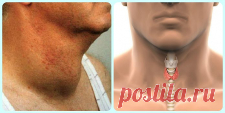 Как быстро избавиться от проблем с щитовидкой! Натуральный и эффективный способ