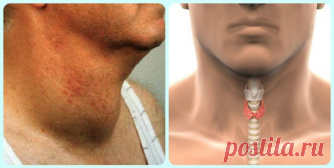 Как быстро избавиться от проблем с щитовидкой! Натуральный и эффективный способ