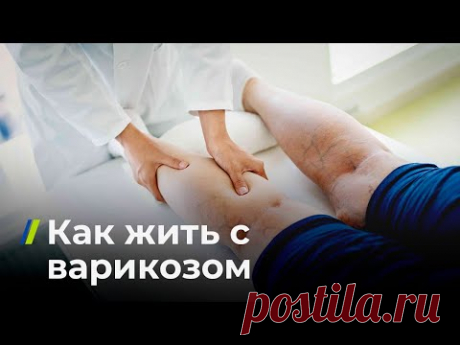 Как жить с варикозом