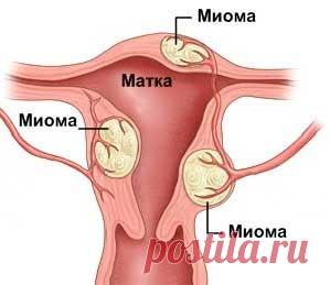 Чем и как лечить миому матки без операции. Препарат Эсмия Компания Гедеон Рихтер предлагает препарат Эсмия - лечение миомы матки. В котором содержится улипристал ацетат, вещество высокой эффективности.