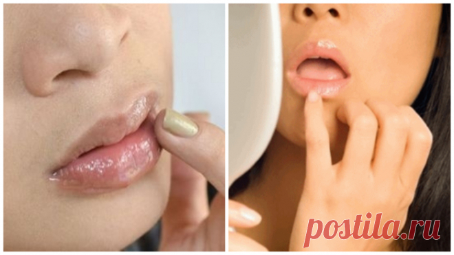Как помочь обветренным губам | Делимся советами