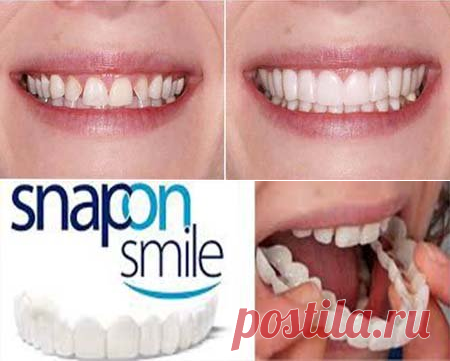 Snap-On Smile | Съемные виниры для красивой улыбки