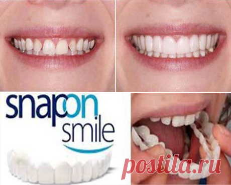 Snap-On Smile | Съемные виниры для красивой улыбки