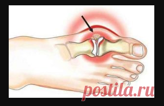 Вальгусная деформация: причины, симптомы, лечение
Вальгусная деформация стопы (hallux valgus), или, как говорят в народе, «косточка» («шишка») у больших пальцев ног, довольно часто встречается у представительниц прекрасного пола.
Вальгусная деформация стоп (hallux valgus) - заболевание, при котором искривляется плюсне-фаланговый сустав первого пальца и деформируются остальные пальцы. Заболевание характеризуется невозможностью ношения обычной обуви | корова крючком
