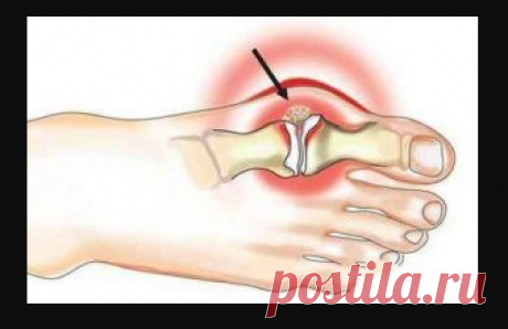 Вальгусная деформация: причины, симптомы, лечение
Вальгусная деформация стопы (hallux valgus), или, как говорят в народе, «косточка» («шишка») у больших пальцев ног, довольно часто встречается у представительниц прекрасного пола.
Вальгусная деформация стоп (hallux valgus) - заболевание, при котором искривляется плюсне-фаланговый сустав первого пальца и деформируются остальные пальцы. Заболевание характеризуется невозможностью ношения обычной обуви | корова крючком