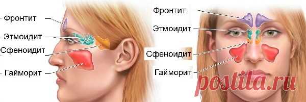 ГАЙМОРИТ: быстрое лечение в домашних условиях у взрослых за 3 дня