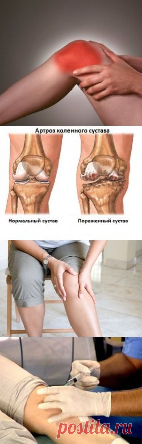 Артроз 1 степени коленного сустава