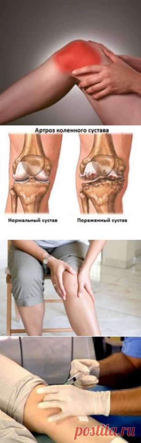 Артроз 1 степени коленного сустава