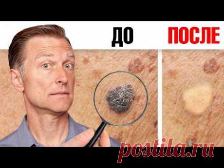 Как избавиться от папиллом и бородавок за ОДНУ ночь?👀