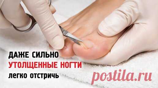 Как легко отстричь даже сильно утолщенные ногти на ногах? Даже у пожилых и лежачих... Лайфхак | Честный Автор | Дзен