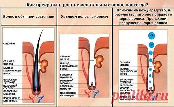 ЙОД ОТ НЕЖЕЛАТЕЛЬНЫХ ВОЛОС!