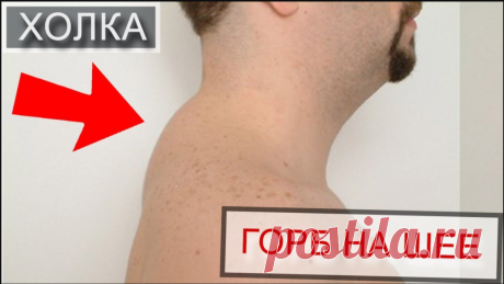 Убрать горб на шее.
Убрать горб на шее — достаточно трудная задача, поэтому лучше с этим заболеванием вовсе не сталкиваться. Избежать появления такого неприятного