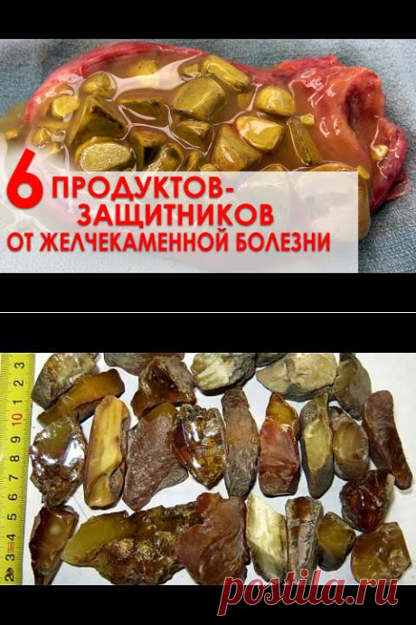 КАК ЛЕЧИТЬ КАМНИ В ЖЕЛЧНОМ ПУЗЫРЕ - YouTube