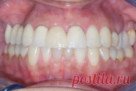 Реабилитация почти безуспешных (2672) - Ортопедия - Новости и статьи по стоматологии - Профессиональный стоматологический портал (сайт) «Клуб стоматологов»