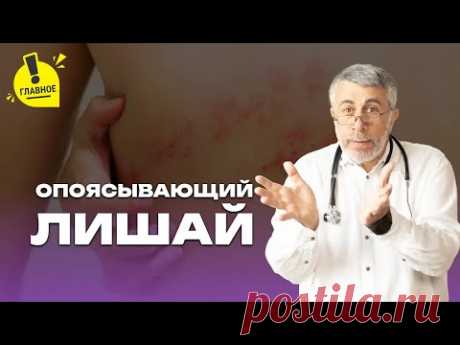 Опоясывающий лишай