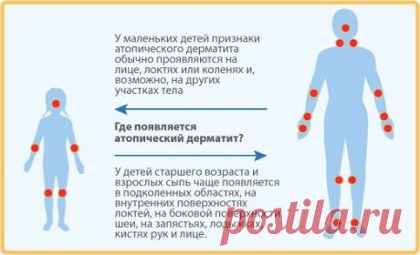 Атопический дерматит. Симптомы и лечение атопического дерматита у детей и взрослых