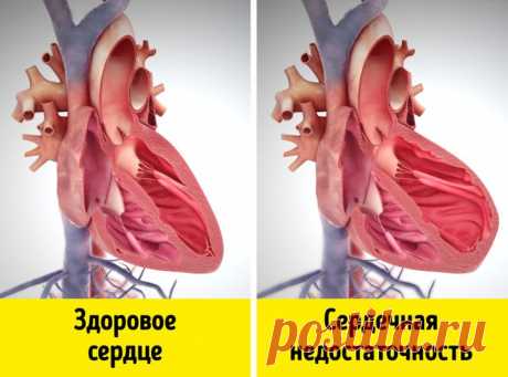 Названы четыре признака сердечной недостаточности.
На наличие сердечной недостаточности могут указывать четыре признака. Их назвал глава кардиологического отделения скорой помощи и интенсивной терапии университетской клиники Лилля, профессор Николас Ламблена, пишет издание Le Figaro.
