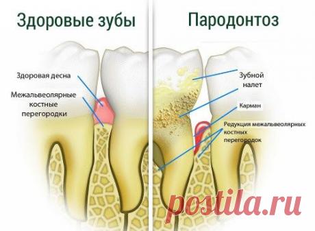 Как лечить пародонтоз в домашних условиях