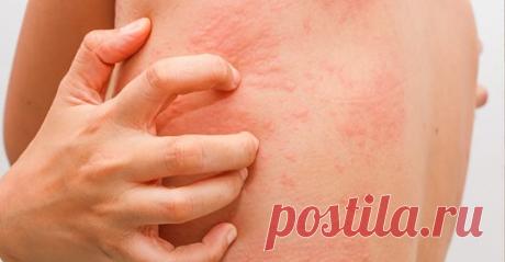 10 признаков того, у вас может быть дефицит цинка Цинк – неимоверно важный компонент, который поддерживает здоровье нашего тела. Этот минерал ответствен за многие системы тела, поэтому недостаток этого мощного питательного вещества может иметь дискре…