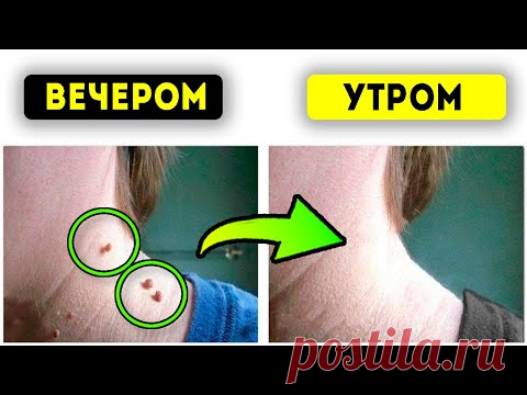 Вывалятся с корнем! Папилломы, бородавки и кондиломы уничтожит раствор копеечной…