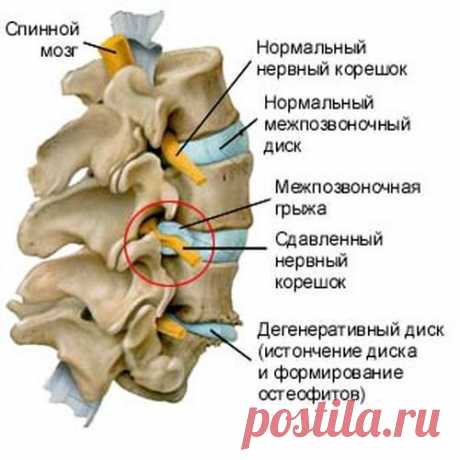 Межпозвоночная грыжа - причины, симптомы и лечение