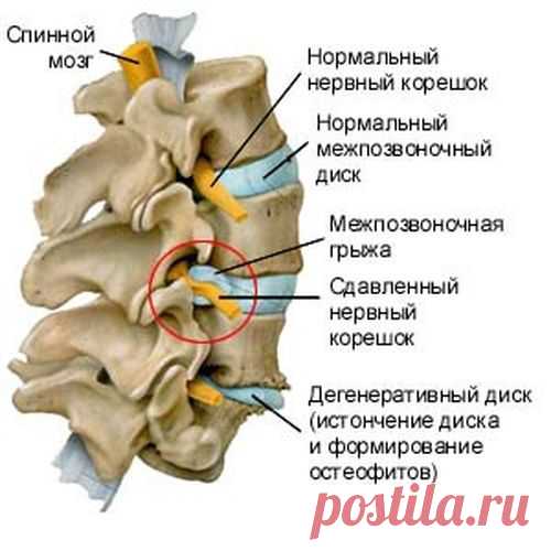 Межпозвоночная грыжа - причины, симптомы и лечение