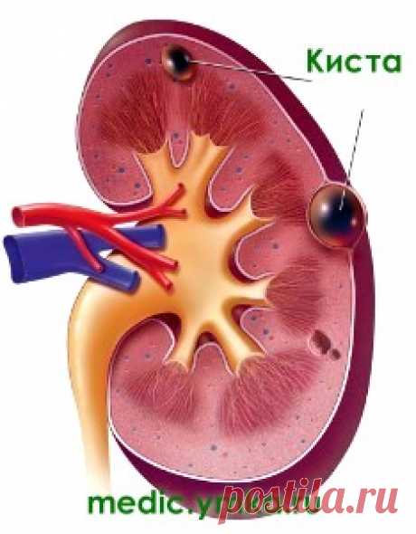Киста почки - симптомы и лечение народными средствами