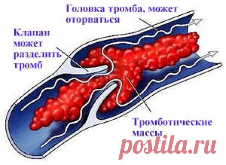 Как избежать операции при тромбофлебите....