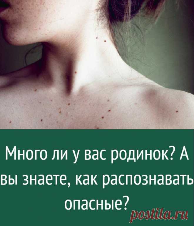 Много ли у вас родинок? А вы знаете, как распознавать опасные?