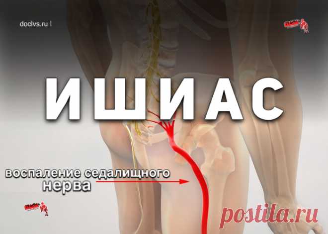 Ишиас (воспаление седалищного нерва): причины, симптомы, диагностика, лечение и рекомендации, последствия и осложнения Ишиас — воспаление седалищного нерва в области таза и верхней части бедра (этот нерв идет до подколенной ямки и дальше до самой стопы). Ишиас также называют пояснично-крестцовым радикулитом или невралгией седалищного нерва