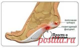 СТУПНИ НОГ. ЧТО ДЕЛАТЬ?