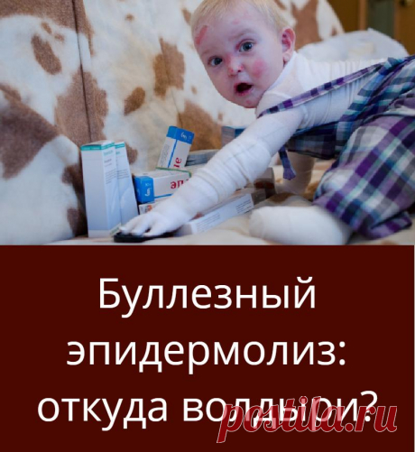 Буллезный эпидермолиз: откуда волдыри?