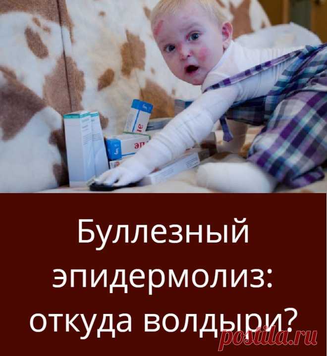 Буллезный эпидермолиз: откуда волдыри?