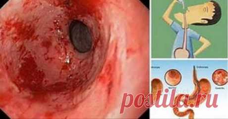 Забудьте о гастрите и изжоге с помощью этого мощного средства!